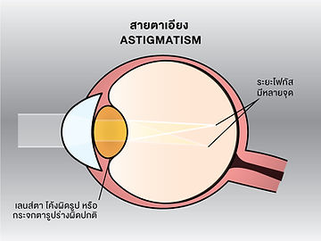 สายตาเอียงต้องใช้เลนส์อะไรให้เหมาะกับอาการ